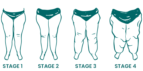 Lipedema - A Medical or Aesthetical Condition And How To Treat It